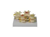 310_ZM2077_Модель патологий позвонков (на подставке)  1