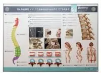 310_МУ0074_Стенд_патологии_позвоночного_столба