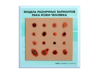 Модель различных вариантов рака кожи человека