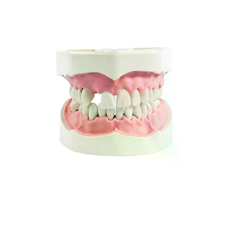 Модель верхней и нижней челюстей c имитацией поздней стадии пародонтита и зубного камня PD-PM — купить в МЕДСЕТ