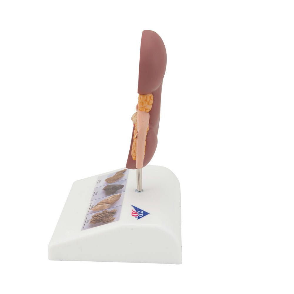 Модель камня почки — купить в МЕДСЕТ