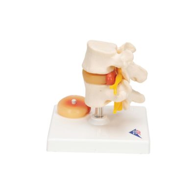 Модель поясничного отдела позвоночника с пролапсом  межпозвонкового диска — купить в МЕДСЕТ