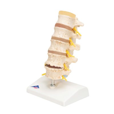 Модель стадий пролапса диска — купить в МЕДСЕТ