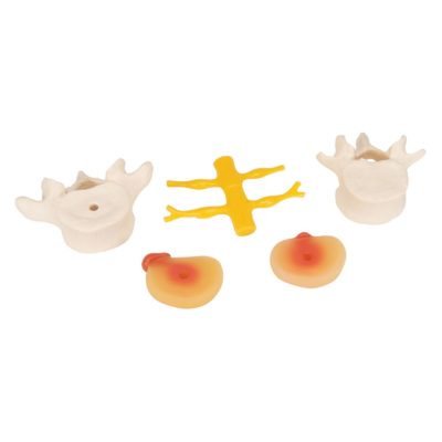 Модель поясничного отдела позвоночника с пролапсом  межпозвонкового диска — купить в МЕДСЕТ