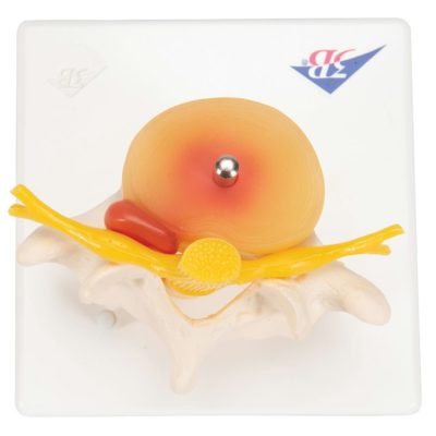 Модель поясничного отдела позвоночника с пролапсом  межпозвонкового диска — купить в МЕДСЕТ