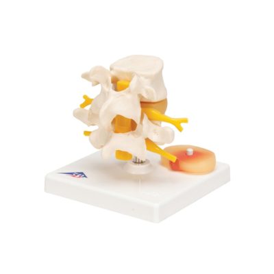 Модель поясничного отдела позвоночника с пролапсом  межпозвонкового диска — купить в МЕДСЕТ