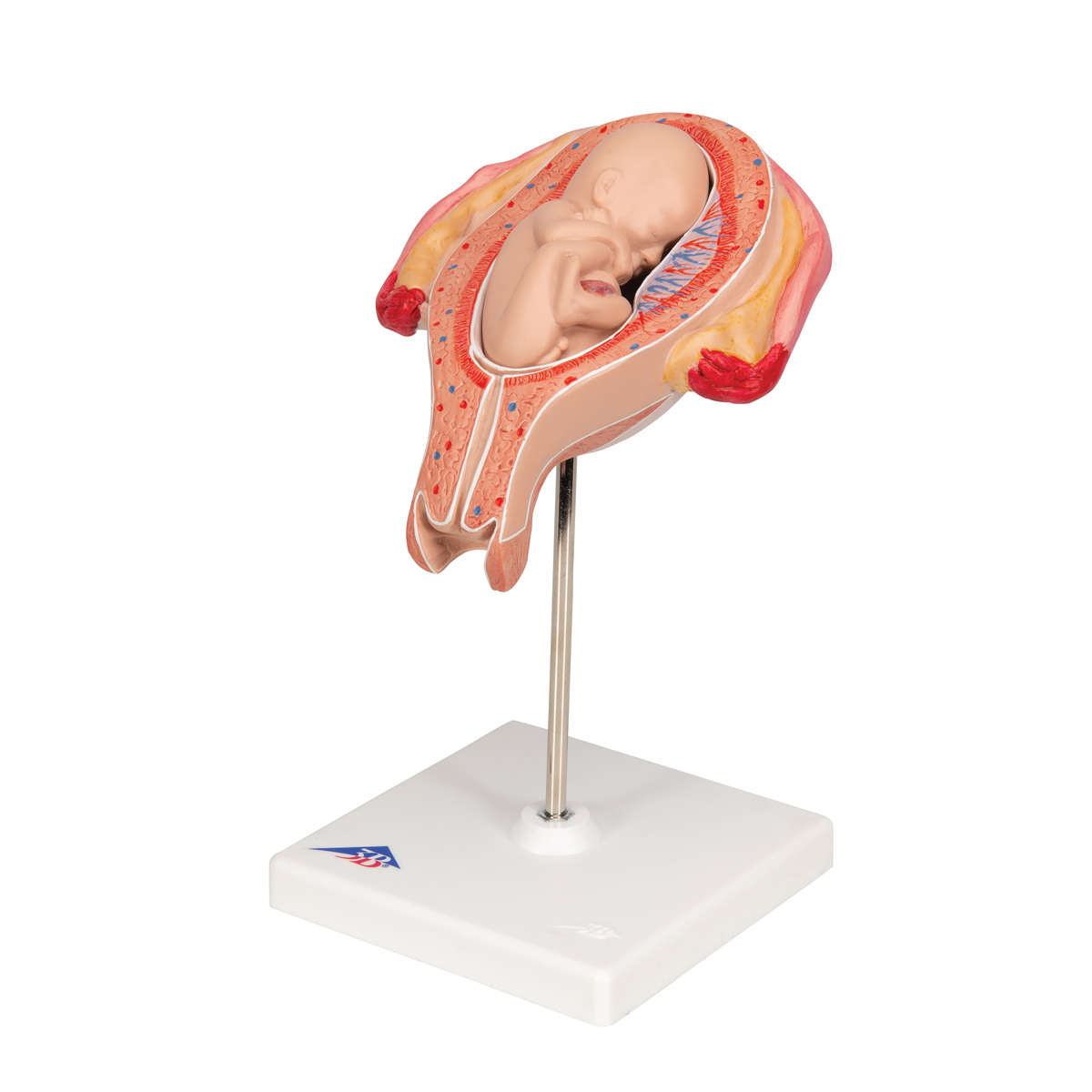 5-месячный плод ,тазовое предлежание — купить в МЕДСЕТ