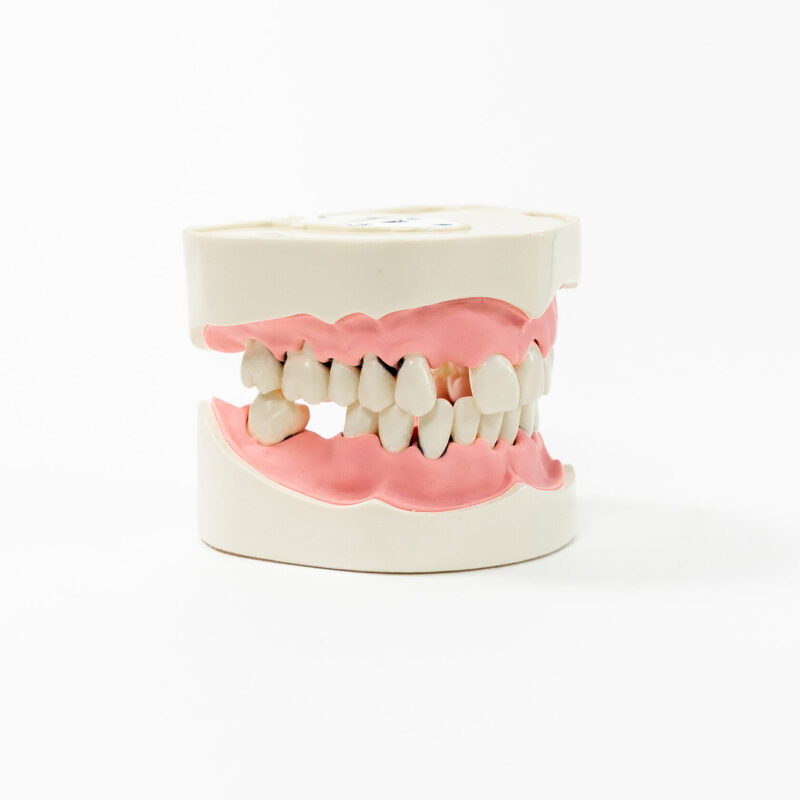 Модель верхней и нижней челюстей c имитацией поздней стадии пародонтита и зубного камня PD-PM — купить в МЕДСЕТ