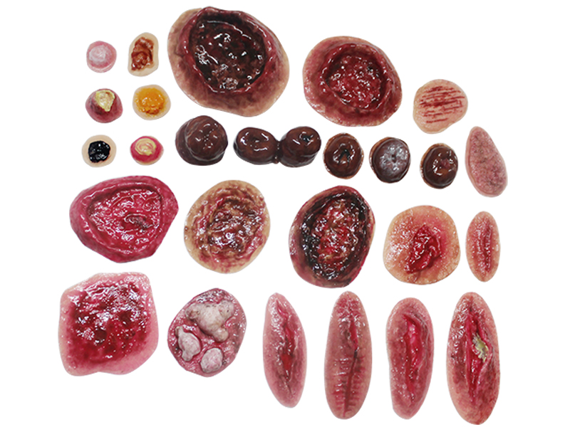 Комплект накладных моделей заболеваний и повреждений кожных покровов человека КР-Н 1.01 — купить в МЕДСЕТ