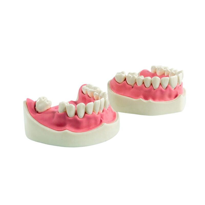 Модель верхней и нижней челюстей c имитацией поздней стадии пародонтита PD-PM — купить в МЕДСЕТ