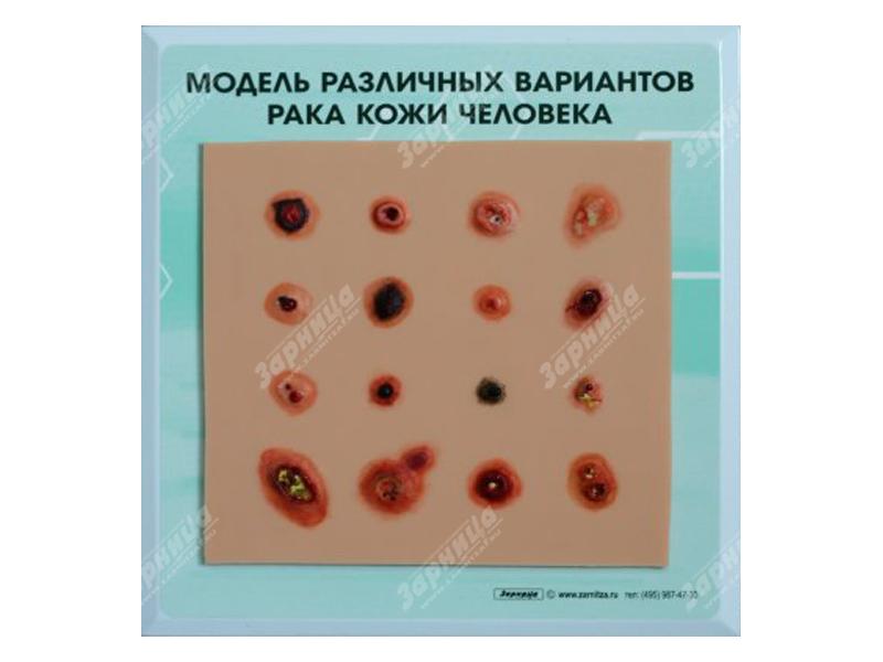 Модель различных вариантов рака кожи человека — купить в МЕДСЕТ