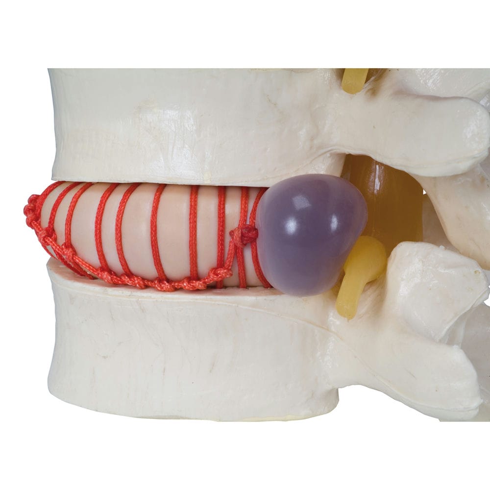 Имитатор грыжи межпозвонкового диска — купить в МЕДСЕТ