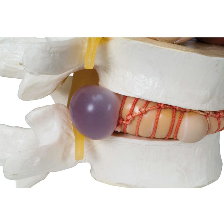 Имитатор грыжи межпозвонкового диска — купить в МЕДСЕТ