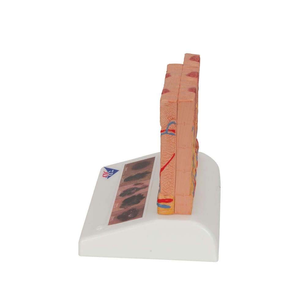 Модель рака кожи — купить в МЕДСЕТ