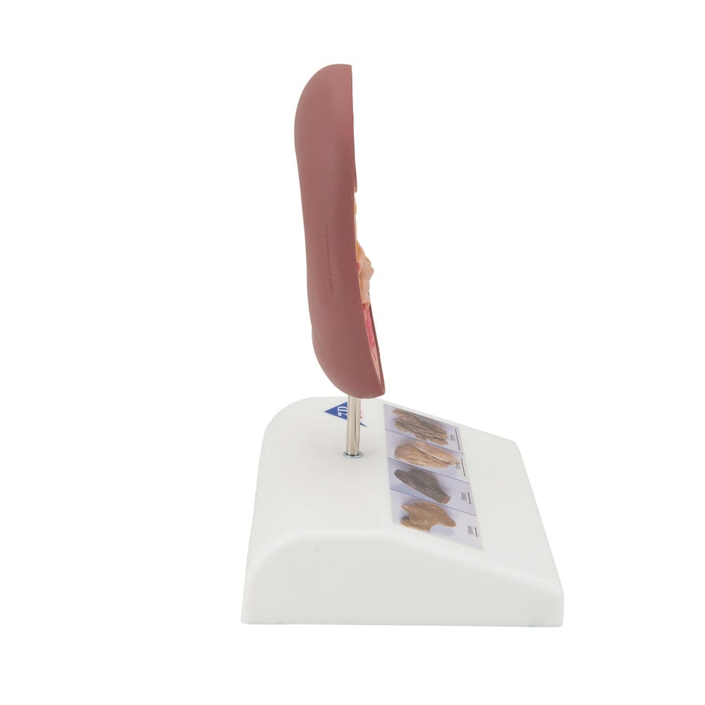 Модель камня почки — купить в МЕДСЕТ