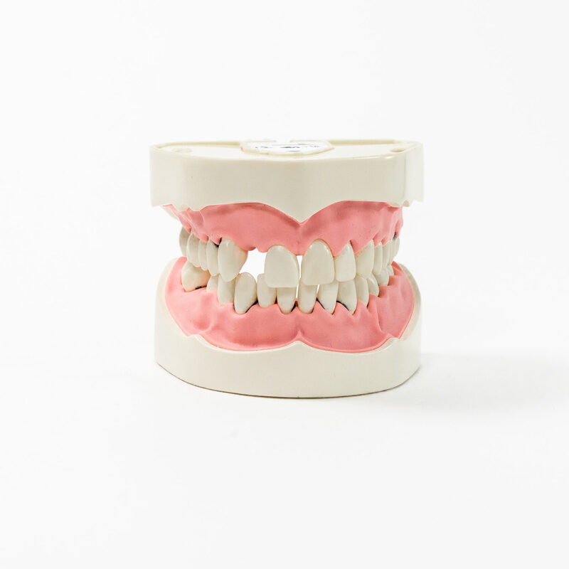 Модель верхней и нижней челюстей c имитацией поздней стадии пародонтита и зубного камня PD-PM — купить в МЕДСЕТ