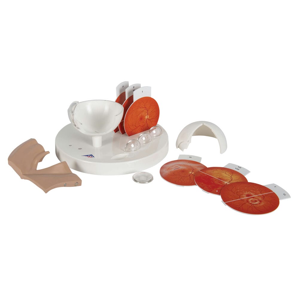 Модель Патологические изменения глаза, в 5-й кратном увеличении — купить в МЕДСЕТ