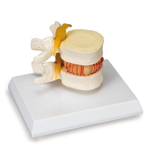 Имитатор грыжи межпозвонкового диска — купить в МЕДСЕТ