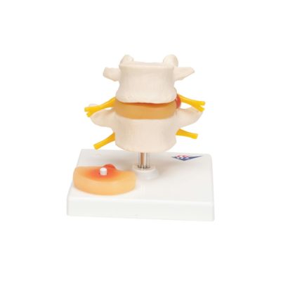 Модель поясничного отдела позвоночника с пролапсом  межпозвонкового диска — купить в МЕДСЕТ