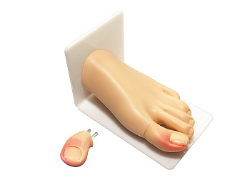 Тренажер для удаления вросшего ногтя — фото